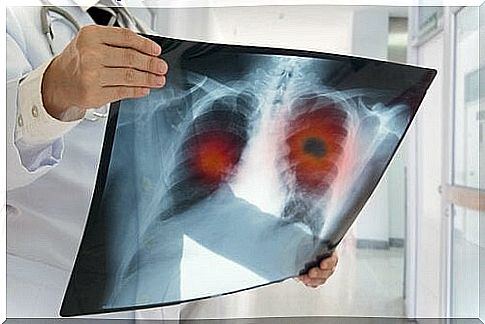 x-rays for fibrosis