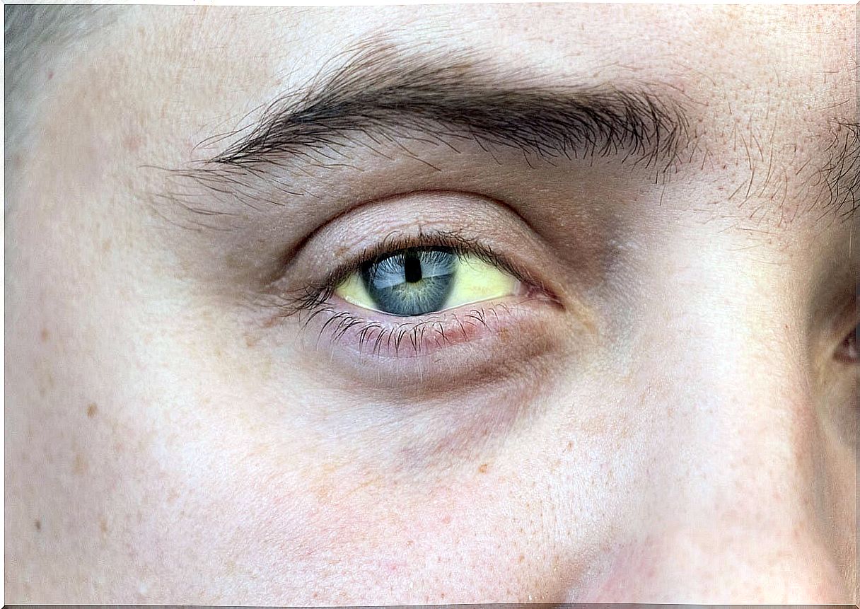 Woman with yellow eyes, characteristic of hepatitis C.