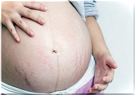 How to prevent stretch marks during pregnancy?