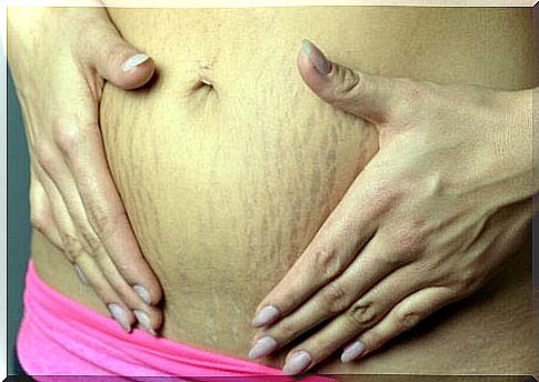 How to remove stretch marks during pregnancy