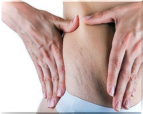 stretch marks during pregnancy