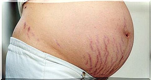 stretch marks during pregnancy