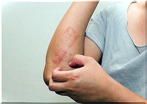 Psoriasis in Children: How Does It Affect Them?