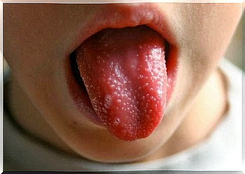 symptom of scarlet fever