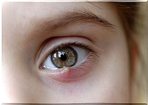 Styes in children: what to do and how to cure them?