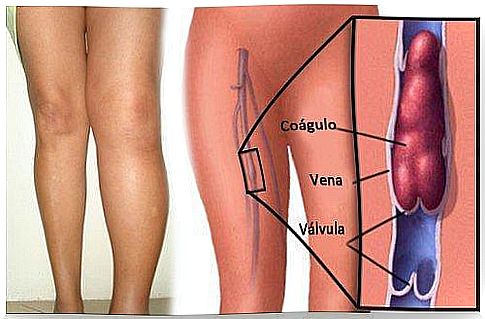 The scheme of thrombosis