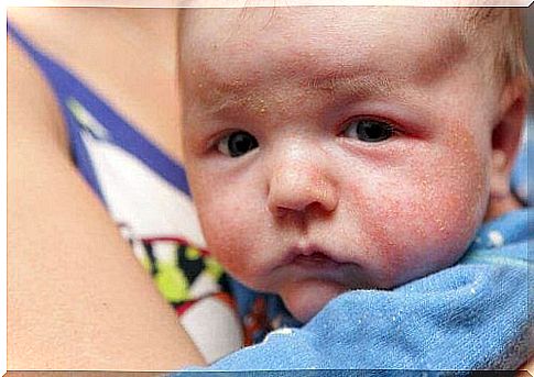 Treating babies' rashes