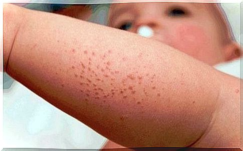 Tips for fighting rashes