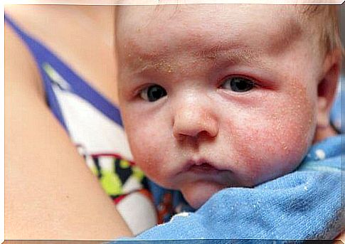 plaques on the skin of the newborn